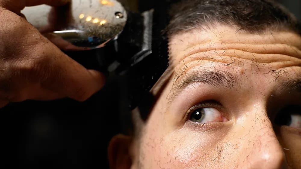 Türkei haartransplantation: Eine dauerhafte Lösung für Haarausfall