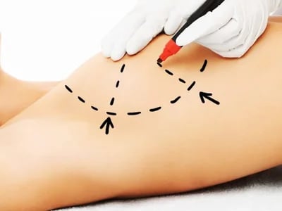 Brustvergrößerung und Straffung: Plastische Chirurgie Bochum informiert