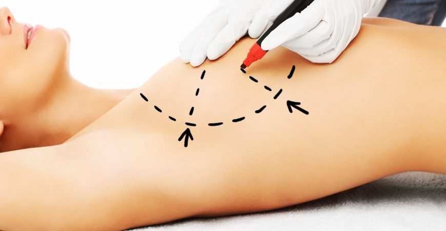 Brustvergrößerung und Straffung: Plastische Chirurgie Bochum informiert